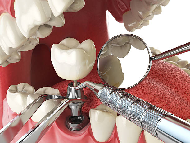 Best Dentist for Tooth Abscess  in Porter Heights, TX